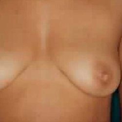 Breast Augmentation Before & After Patient #2242