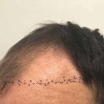Hair Restoration Before & After Patient #2784