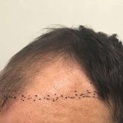 Hair Restoration Before & After Patient #2784