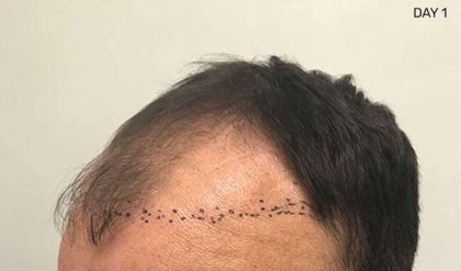 Hair Restoration Before & After Patient #2784