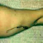 Liposuction Before & After Patient #2867
