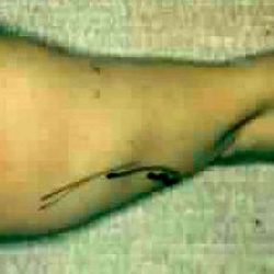 Liposuction Before & After Patient #2867
