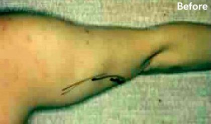 Liposuction Before & After Patient #2867