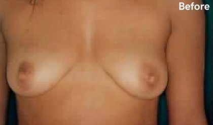 Breast Augmentation Before & After Patient #2242