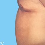 Liposuction Male Before & After Patient #2909