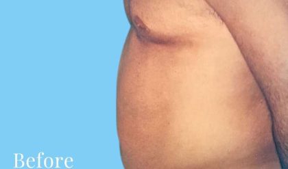 Liposuction Male Before & After Patient #2909