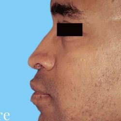 Rhinoplasty Male Before & After Patient #3030