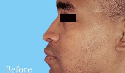 Rhinoplasty Male Before & After Patient #3030