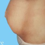 Tummy Tuck Before & After Patient #3069