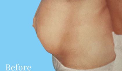 Tummy Tuck Before & After Patient #3069