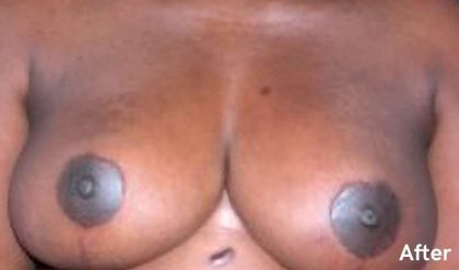 Breast Reduction Before & After Patient #2340