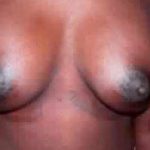 Breast Augmentation Before & After Patient #2233