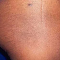 Buttock Augmentation Before & After Patient #2426