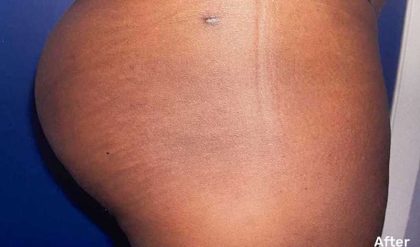 Buttock Augmentation Before & After Patient #2426