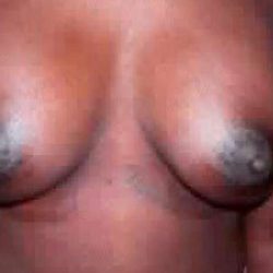 Breast Augmentation Before & After Patient #2233