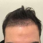 Hair Restoration Before & After Patient #2775