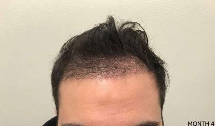 Hair Restoration Before & After Patient #2775