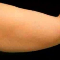 Liposuction Before & After Patient #2858