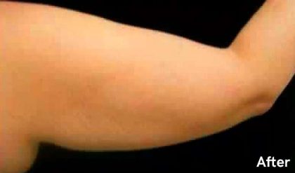 Liposuction Before & After Patient #2858
