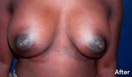 Breast Augmentation Before & After Patient #2233