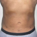 Liposuction Male Before & After Patient #2906