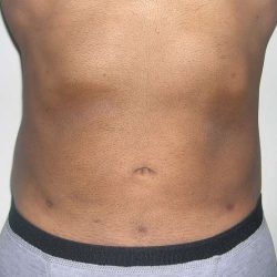 Liposuction Male Before & After Patient #2906