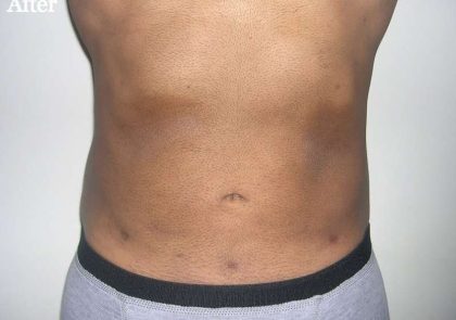 Liposuction Male Before & After Patient #2906