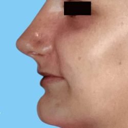 Rhinoplasty Before & After Patient #2982