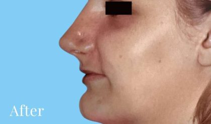 Rhinoplasty Before & After Patient #2982