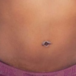 Tummy Tuck Before & After Patient #3066