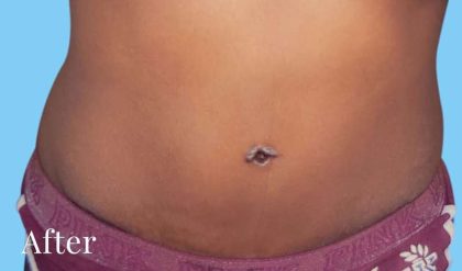Tummy Tuck Before & After Patient #3066