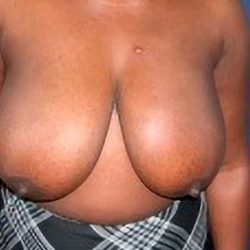 Breast Reduction Before & After Patient #2340