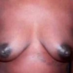Breast Augmentation Before & After Patient #2233