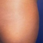 Buttock Augmentation Before & After Patient #2426