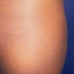 Buttock Augmentation Before & After Patient #2426