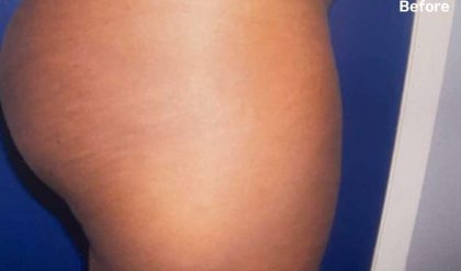 Buttock Augmentation Before & After Patient #2426