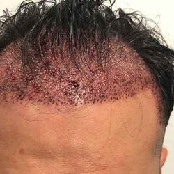 Hair Restoration Before & After Patient #2775