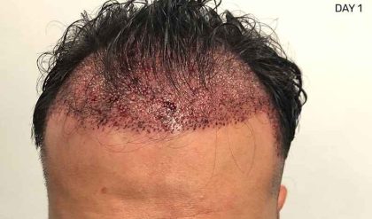 Hair Restoration Before & After Patient #2775