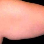 Liposuction Before & After Patient #2858