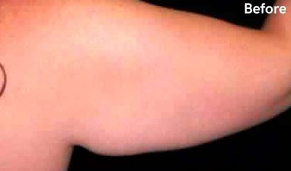 Liposuction Before & After Patient #2858