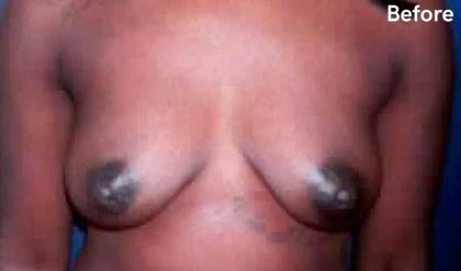 Breast Augmentation Before & After Patient #2233
