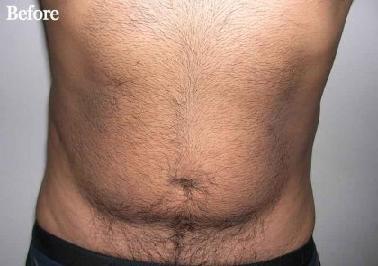 Liposuction Male Before & After Patient #2906