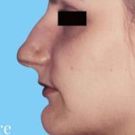 Rhinoplasty Before & After Patient #2982
