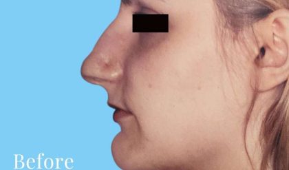Rhinoplasty Before & After Patient #2982