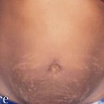 Tummy Tuck Before & After Patient #3066