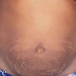 Tummy Tuck Before & After Patient #3066