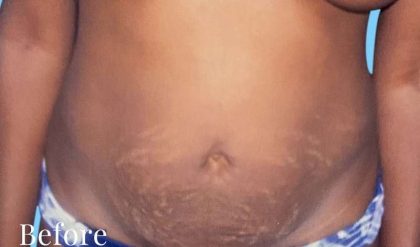 Tummy Tuck Before & After Patient #3066