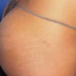 Buttock Augmentation Before & After Patient #2381