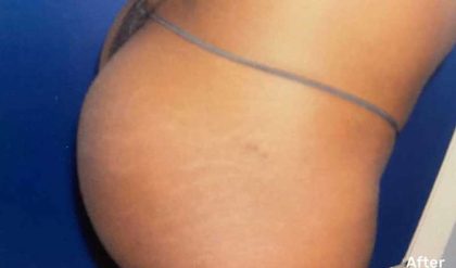 Buttock Augmentation Before & After Patient #2381