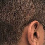 Hair Restoration Before & After Patient #2737